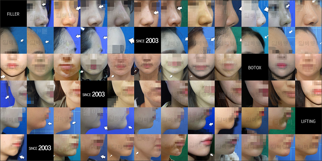 SINCE 2003 MI&MI, 시술후사진모음 수원피부과-수원역피부과 1mm변화, 자신감을 되찾는 수원피부과 미앤미