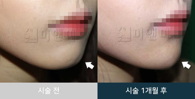 after_Img